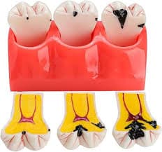 KAR/Y10009-1 Dissected Carious Teeth Dental Model – 4X Magnification